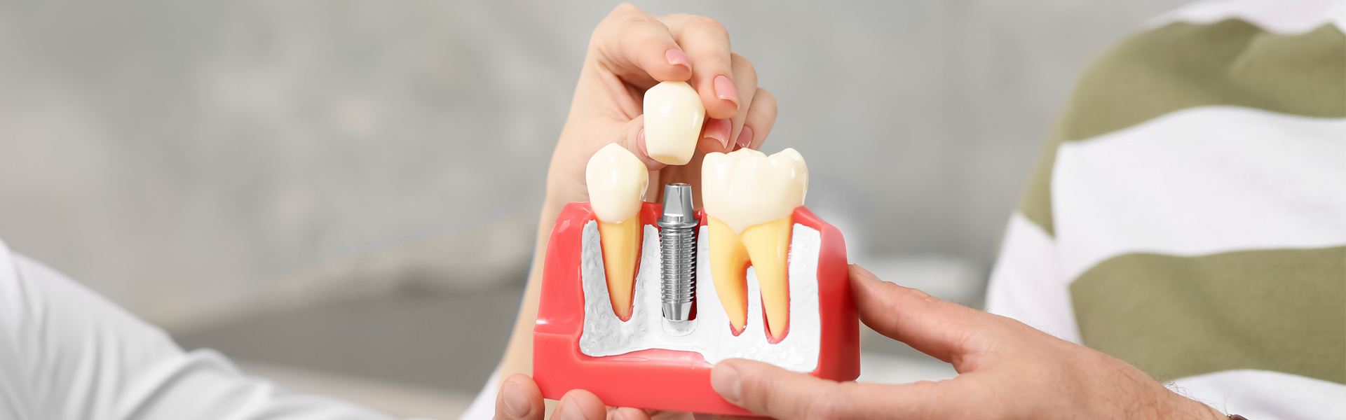 What Are the Benefits of Choosing a Dental Implant Over a Traditional Fixed Bridge?