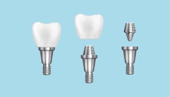 What Are the Benefits of Choosing a Dental Implant Over a Traditional Fixed Bridge?