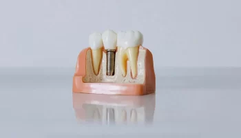 Why Dental Implants Are the Gold Standard for Tooth Replacement in Emerson, NJ?